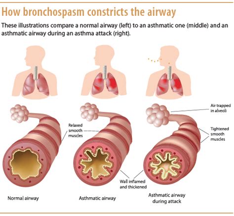 bronchial spasm resulting in decreased air movement